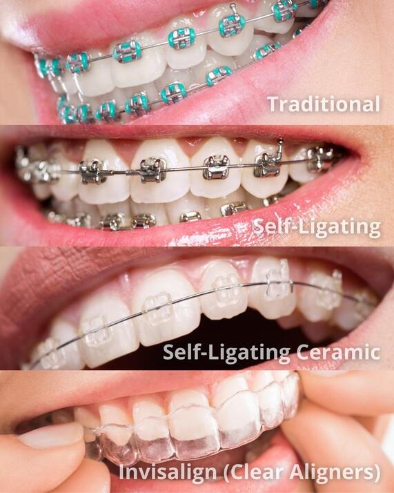 Types of dental braces include metal braces, ceramic braces, self-ligating braces, lingual braces, and clear aligners.